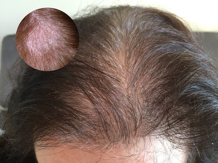 Nguyên nhân rụng tóc do viêm nhiễm da đầu