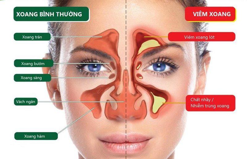 HƯỚNG DẪN LÀM THẾ NÀO KHI BỊ VIÊM XOANG